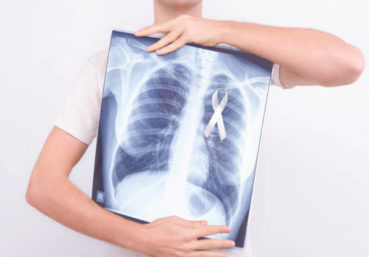 What You Should Know About Lung Cancer - DetecTogether